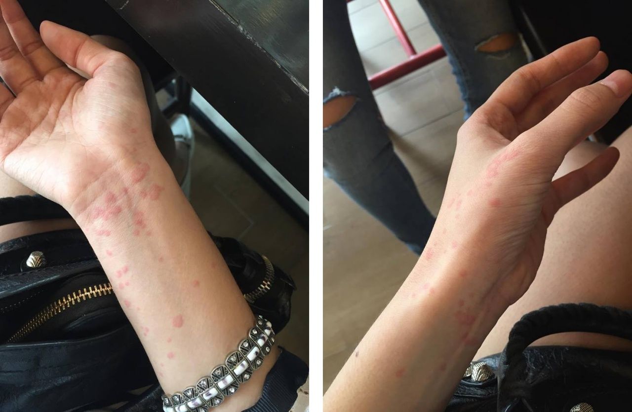 ผื่นเริ่มหาย