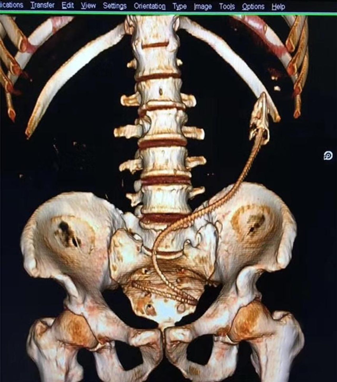 ภาพสแกนแสดงให้เห็นปลาไหลอยู่ในช่องท้องของชายชาวจีน