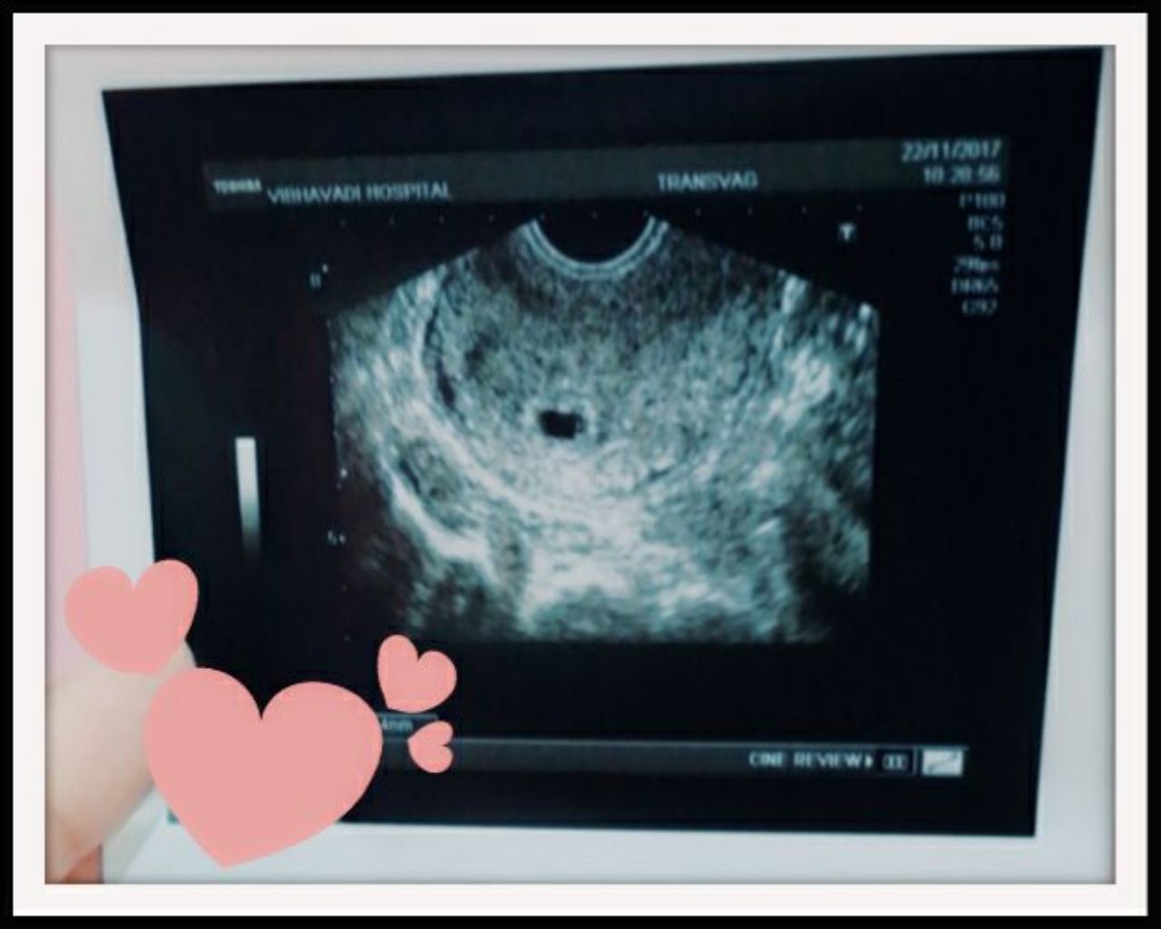 ภาพอัลตร้าซาวนด์ลูกคนที่ 3 ของเอ๊ะและชมพู่