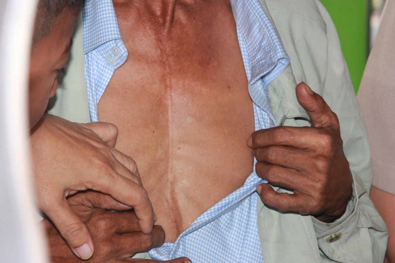 รอยแผลผ่าตัดที่หน้าอกของลุงโรจน์