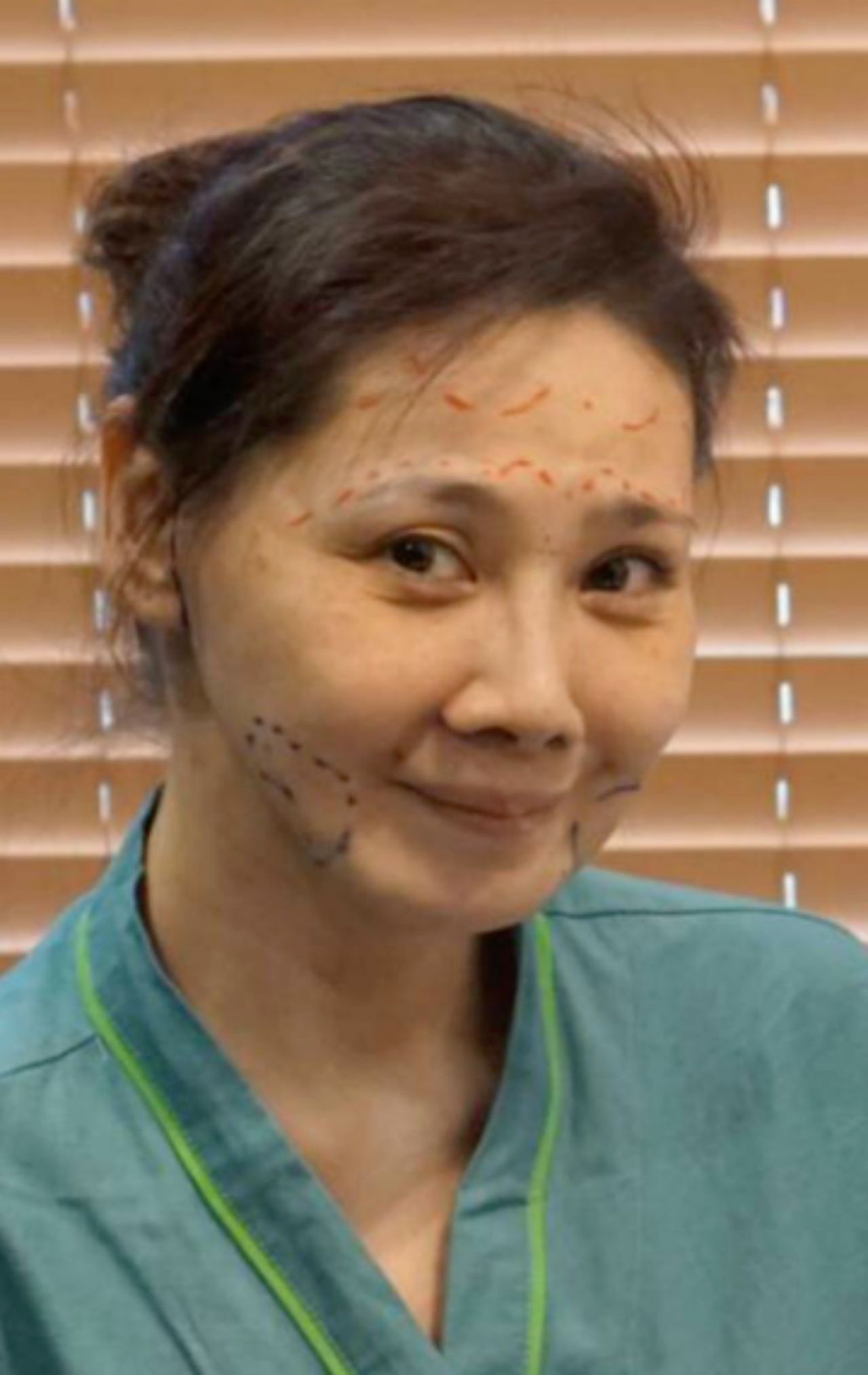 หมอกำหนดจุดก่อนทำศัลยกรรม