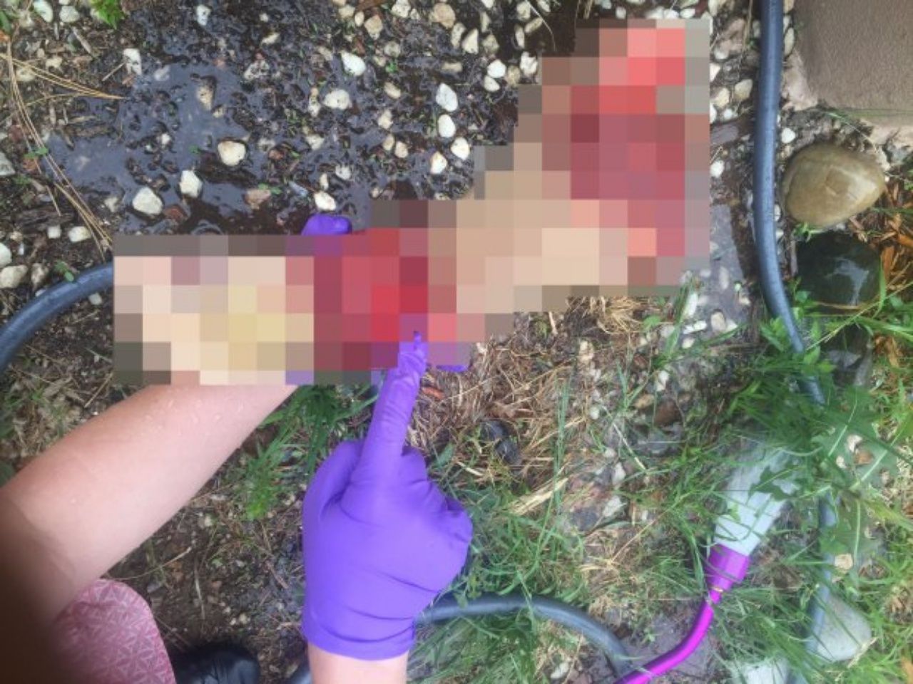 ชายหนุ่มนิรนามทำความสะอาดขาที่ถูกตัดของตัวเอง