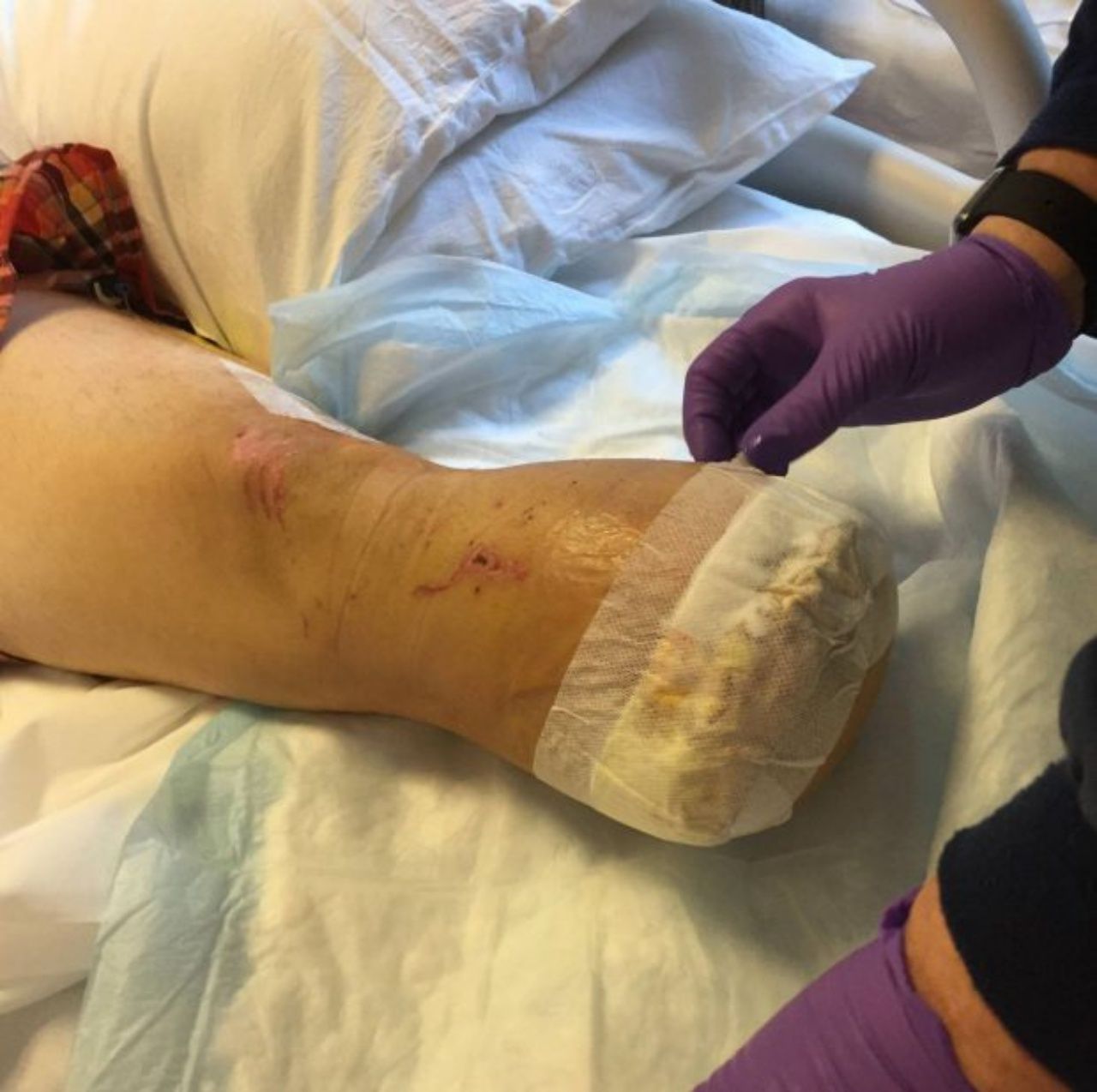 สภาพขาหลังถูกตัด