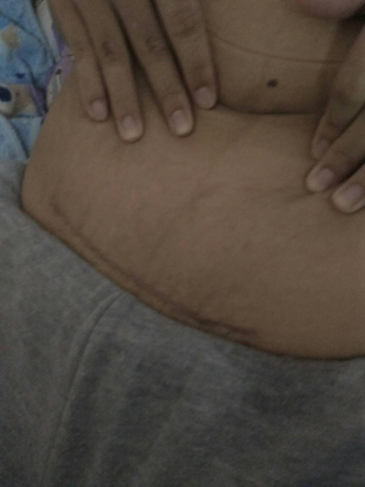 แผลจากการผ่าคลอด เย็บแผลด้วยไหมแบบตัด สีฟ้า สามจุด คือ ซ้าย ขวาและ ตรงกลาง 