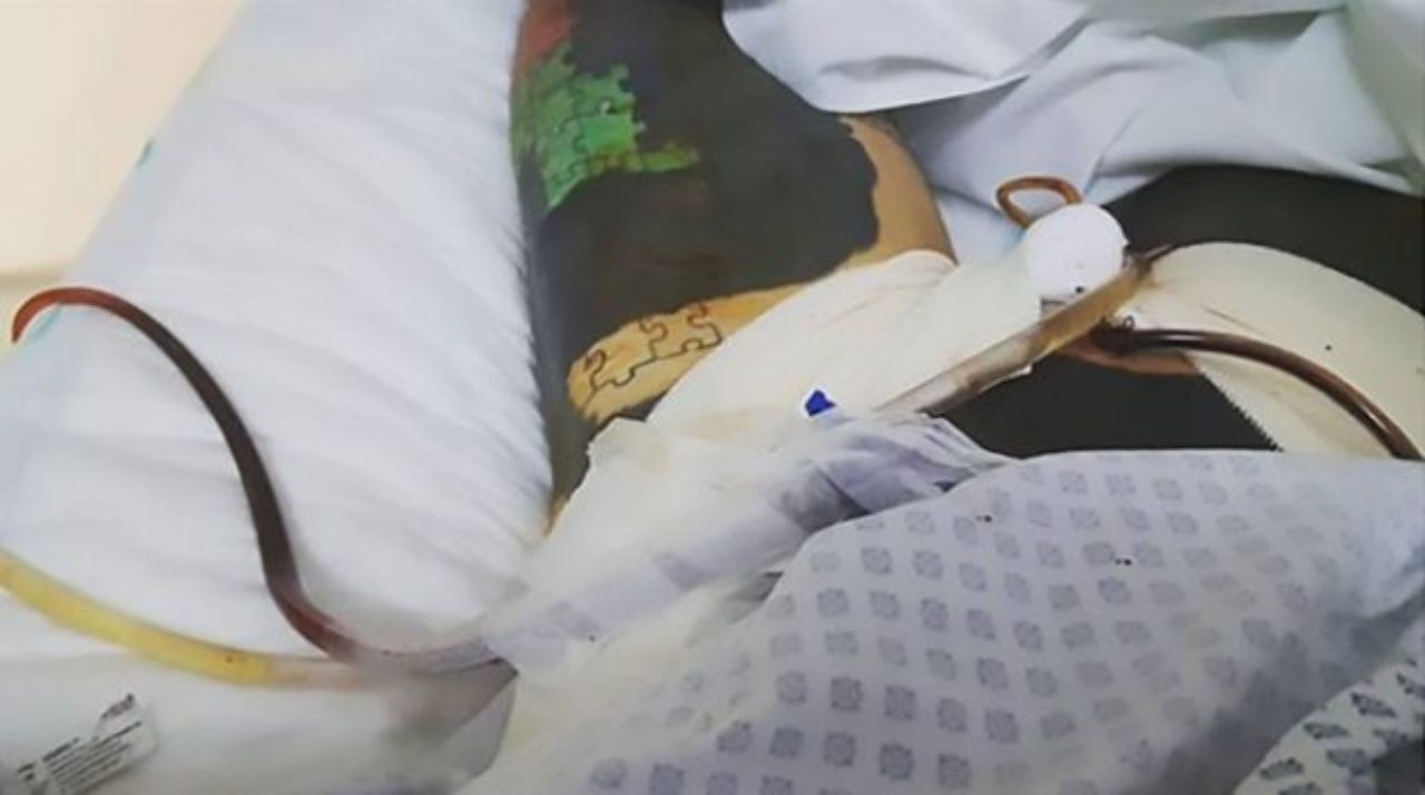 อดัม โพสต์ภาพตัวเองหลังผ่าตัดแล้วลงบนโลกออนไลน์