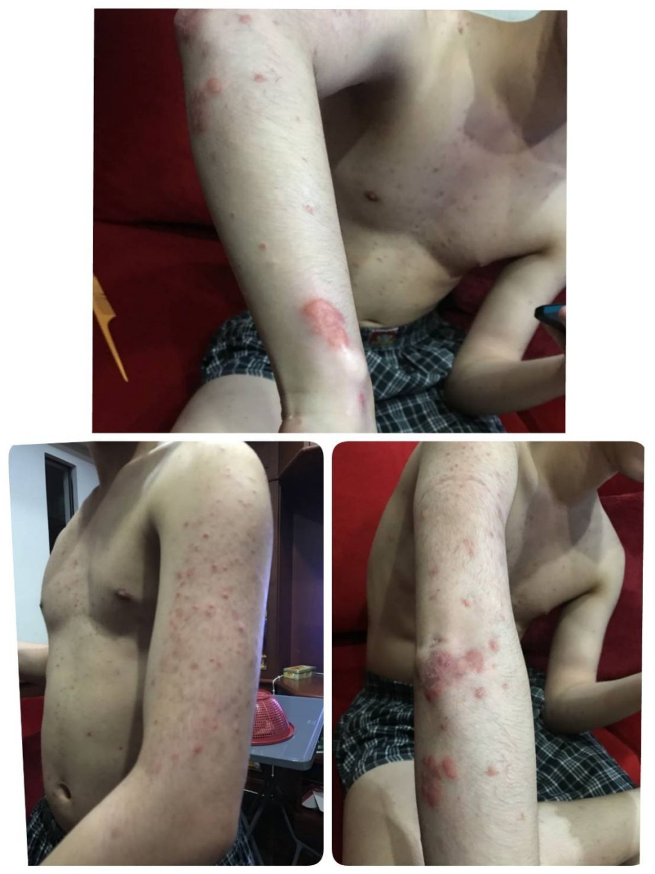 จากที่เป็นที่แขน กลายเป็นเห่อทั่วทั้งตัว 