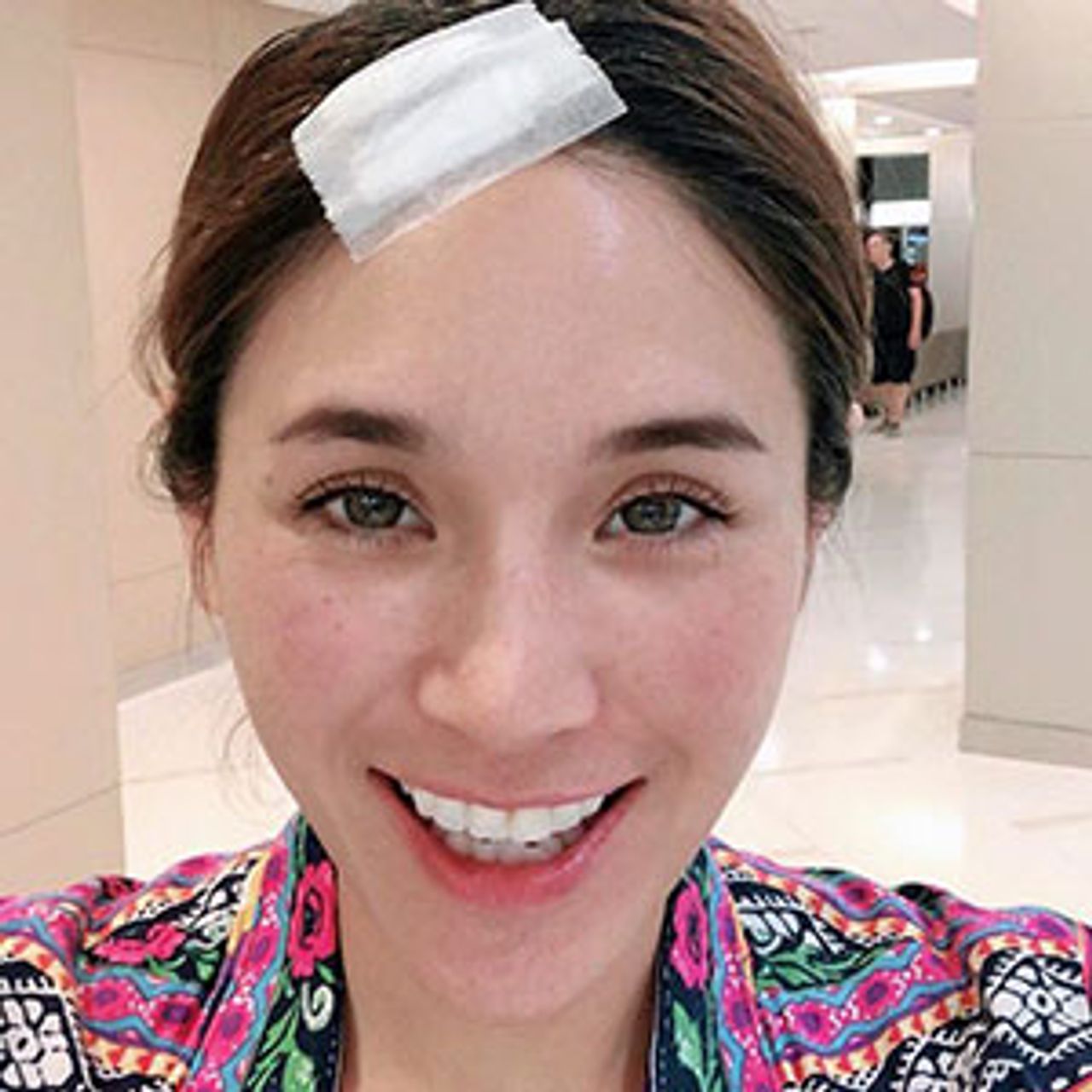 เกิดอุบัติเหตุหัวฟาดขอบรถตู้หัวแตกที่ จ.อุดรธานี จิ๊บ–ปกฉัตร เย็บ 7 เข็ม แต่ไม่ต้องห่วงแผลแตกหายไว มี หนุ่มบอส–พุทธิพงษ์ ดูแลใกล้ชิด ตัดไหมละ หายละ!!