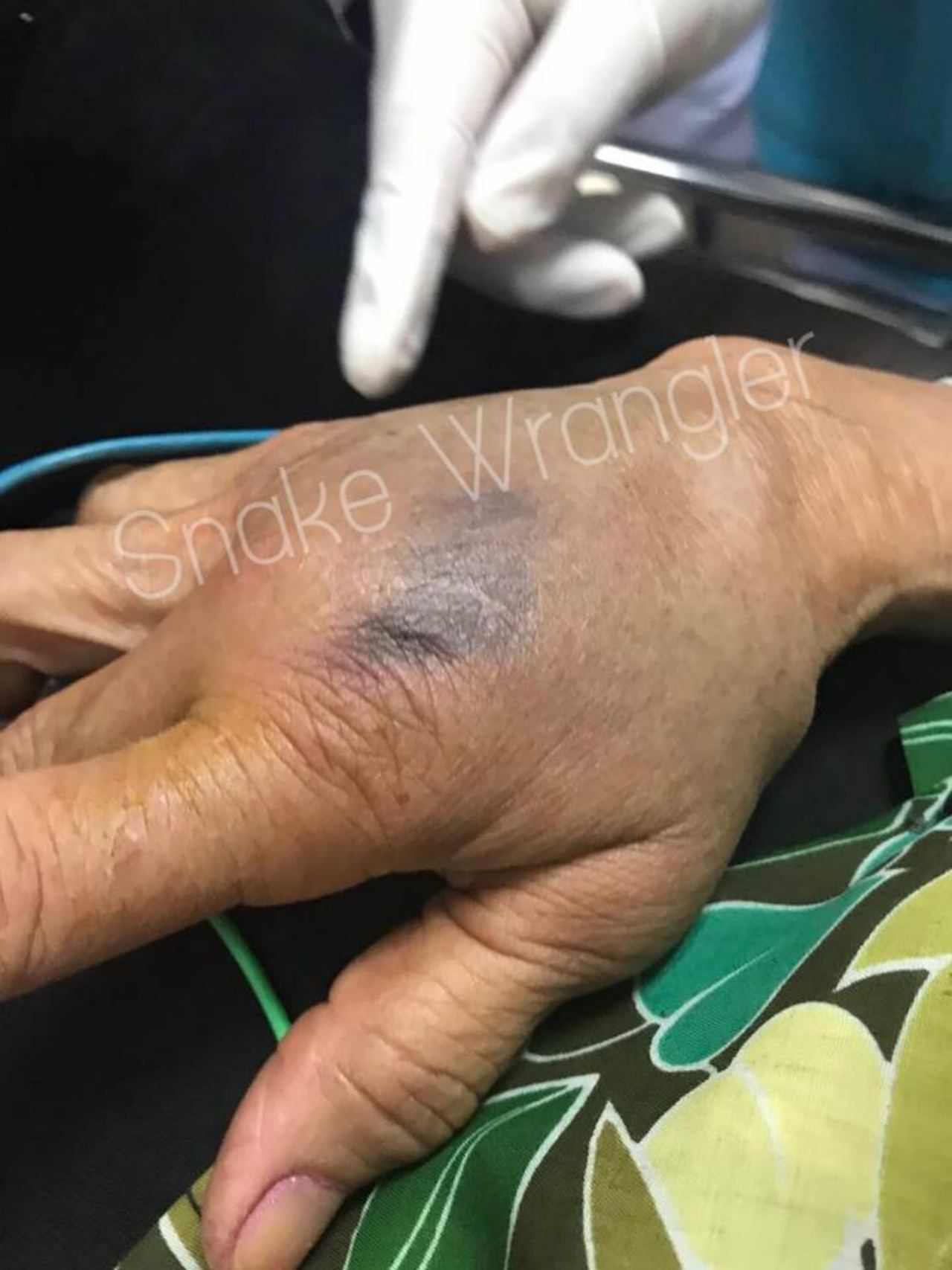 มือของคุณยายผู้ใจดีที่ถูกงูเห่ากัด