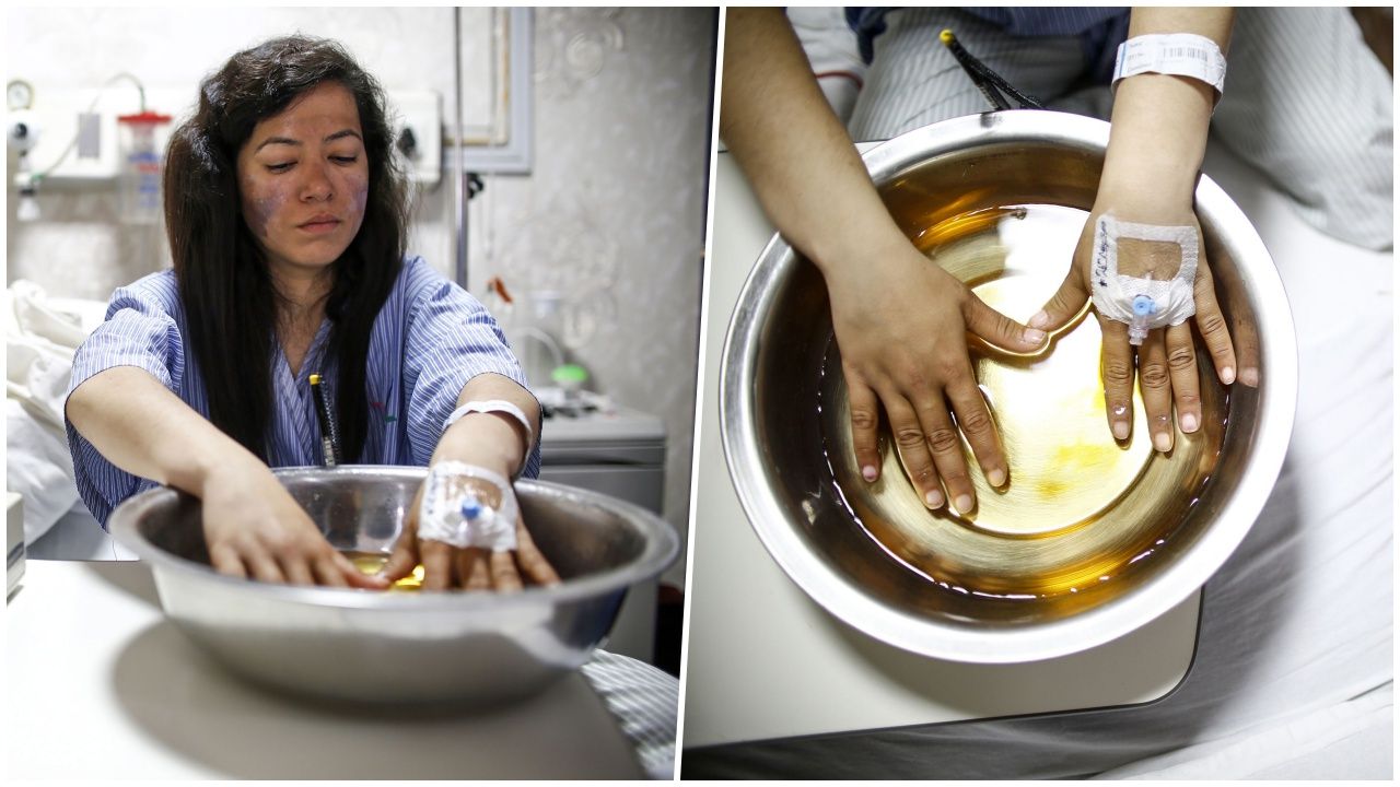 อามีชา เชาฮัน นักปีนเขา สาวชาวอินเดีย แช่มือในน้ำอุ่น อยู่ที่โรงพยาบาลในกรุงกาฎมาณฑุ เมื่อ 27พ.ค.62 หลังเธอเป็นคนหนึ่งที่รอดชีวิต จากการจราจรติดขัดบนเอเวอเรสต์ แต่โดนหิมะกัดจนได้รับบาดเจ็บ