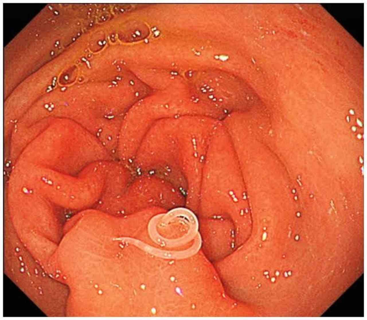 ภาพ : พยาธิอะนิซาคิส (Anisakis simplex)