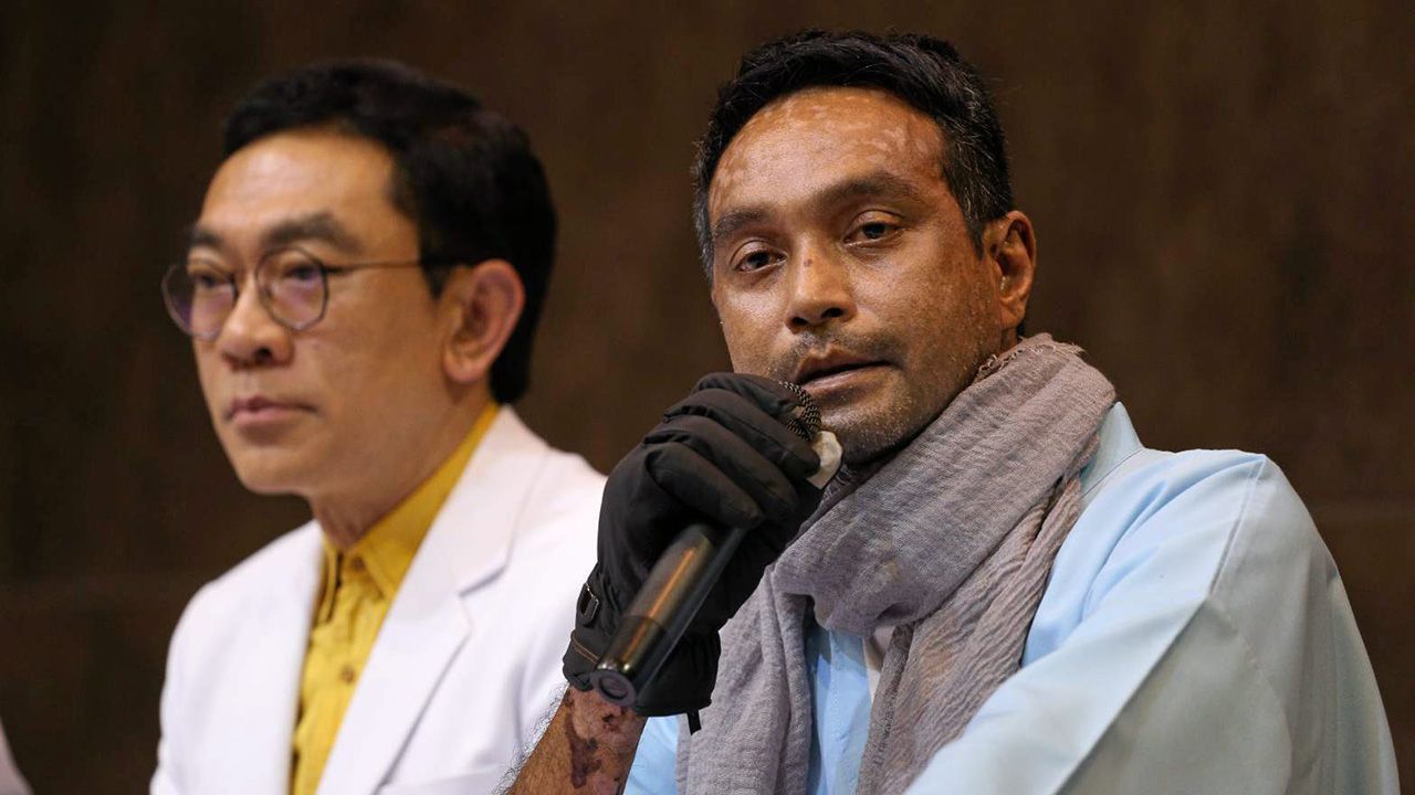 เมฆ วินัย ไกรบุตร อดีตดาราดังที่ป่วยเป็นโรคตุ่มน้ำพอง