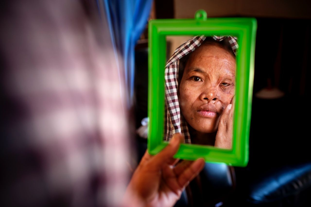 น้ำกรด ไม่ได้ทิ้งบาดแผลภายนอกที่รักษาไม่หายเท่านั้น แต่ยังฝังรากลึกไปถึงจิตใจภายในอีกด้วย