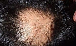 ฉีดโบทอกซ์ แก้หัวล้าน นักวิทยาศาสตร์ยิว กำลังเฝ้าติดตามดูผล