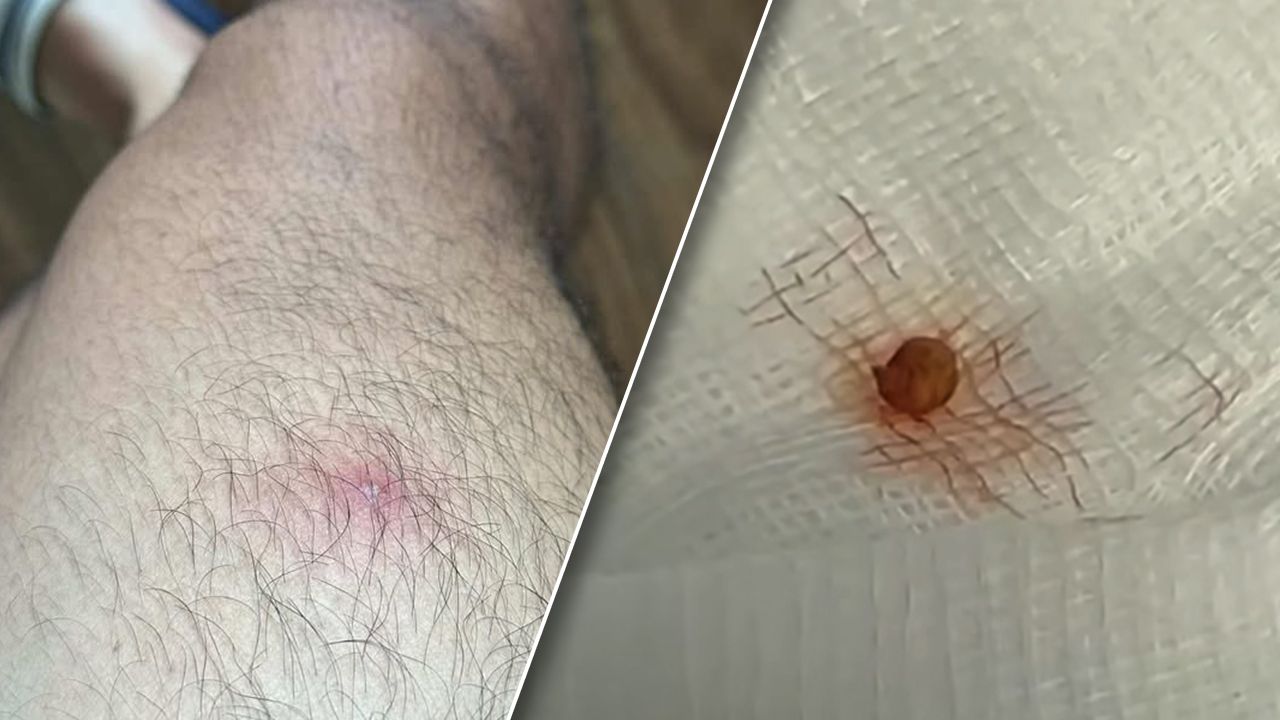 หนุ่มไทยแชร์ประสบการณ์ตัวอ่อนแมลงวันมะม่วงไชเข้าผิวหนัง