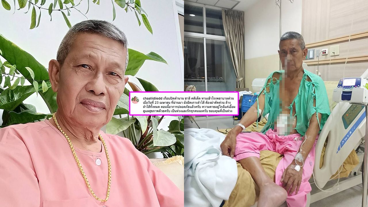 ชาลี คดีเด็ด เกือบปิดตำนาน ผ่าตัดลำไส้ด่วน ปลอดภัยแล้ว