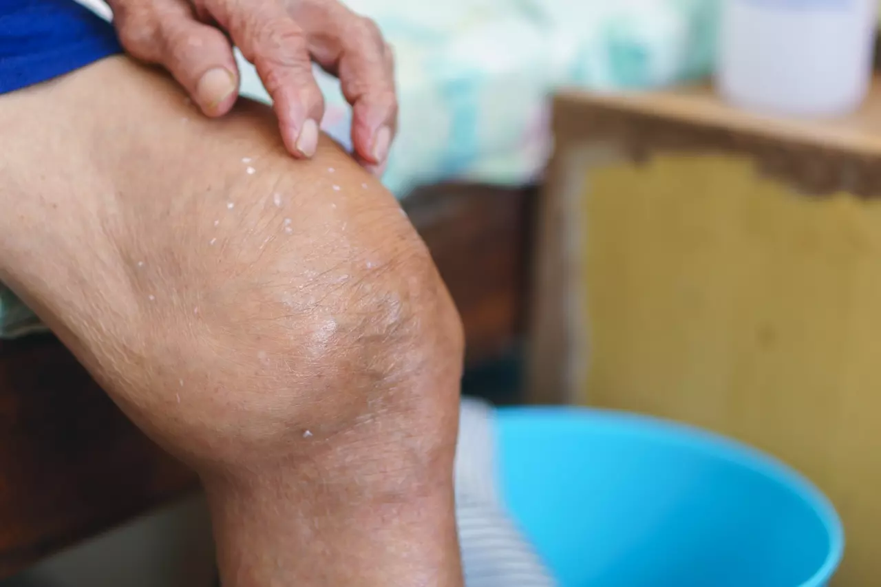 “ข้อเสื่อม” โรคฮิตหน้าหนาวผู้สูงวัย แนะ 9 วิธีป้องกัน ก่อนลามโรครูมาตอยด์