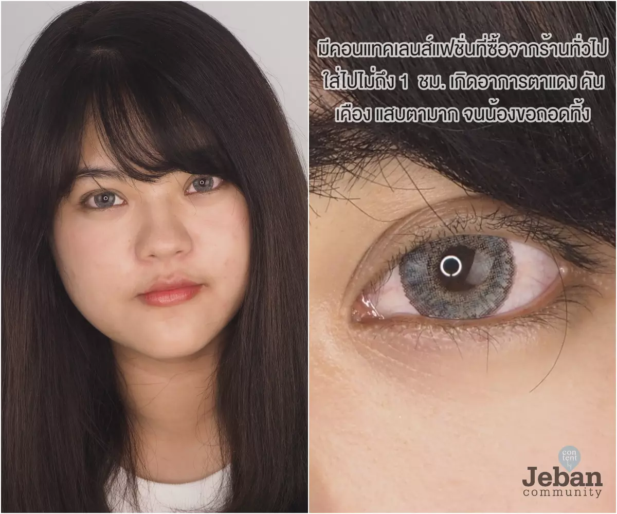  7 คอนแทคเลนส์ บิ๊กอาย เลือกยังไงให้ใส่สบาย ไม่เคืองตา 