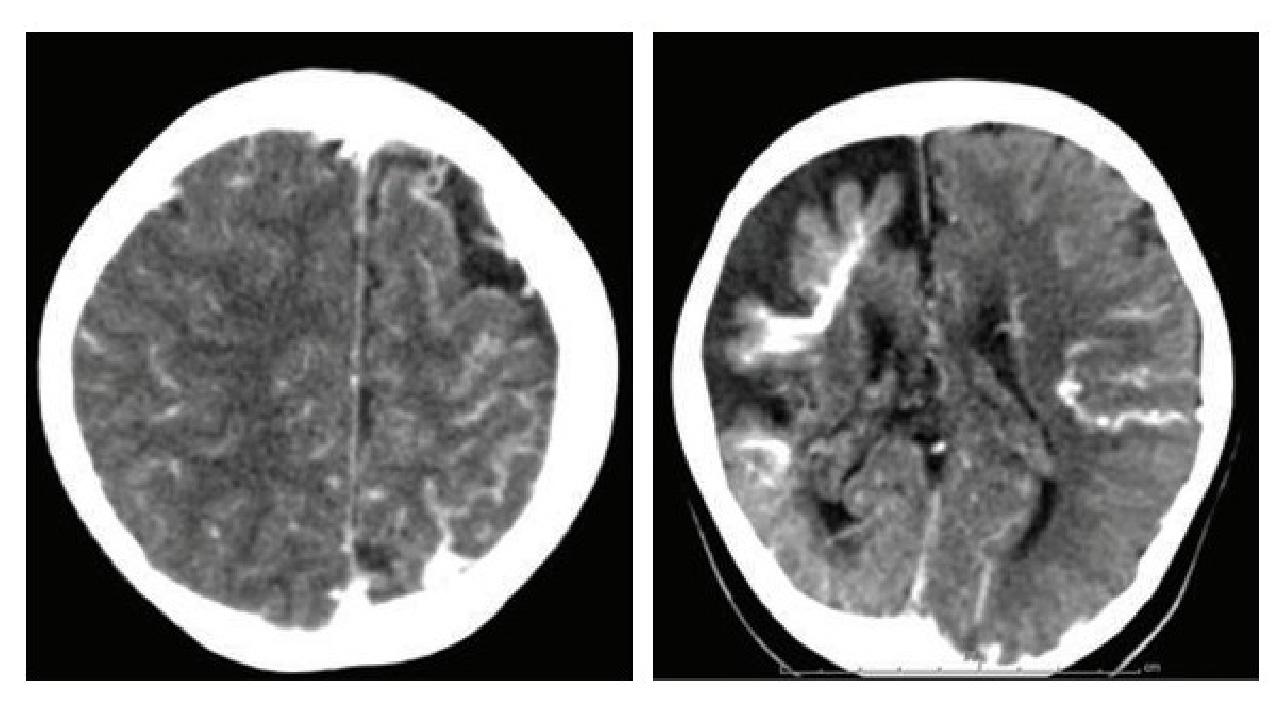 รู้จักกับโรคหายาก Sturge-Weber Syndrome พบปานแดง ต้อหิน และชัก ต้องรักษาตลอดชีวิต