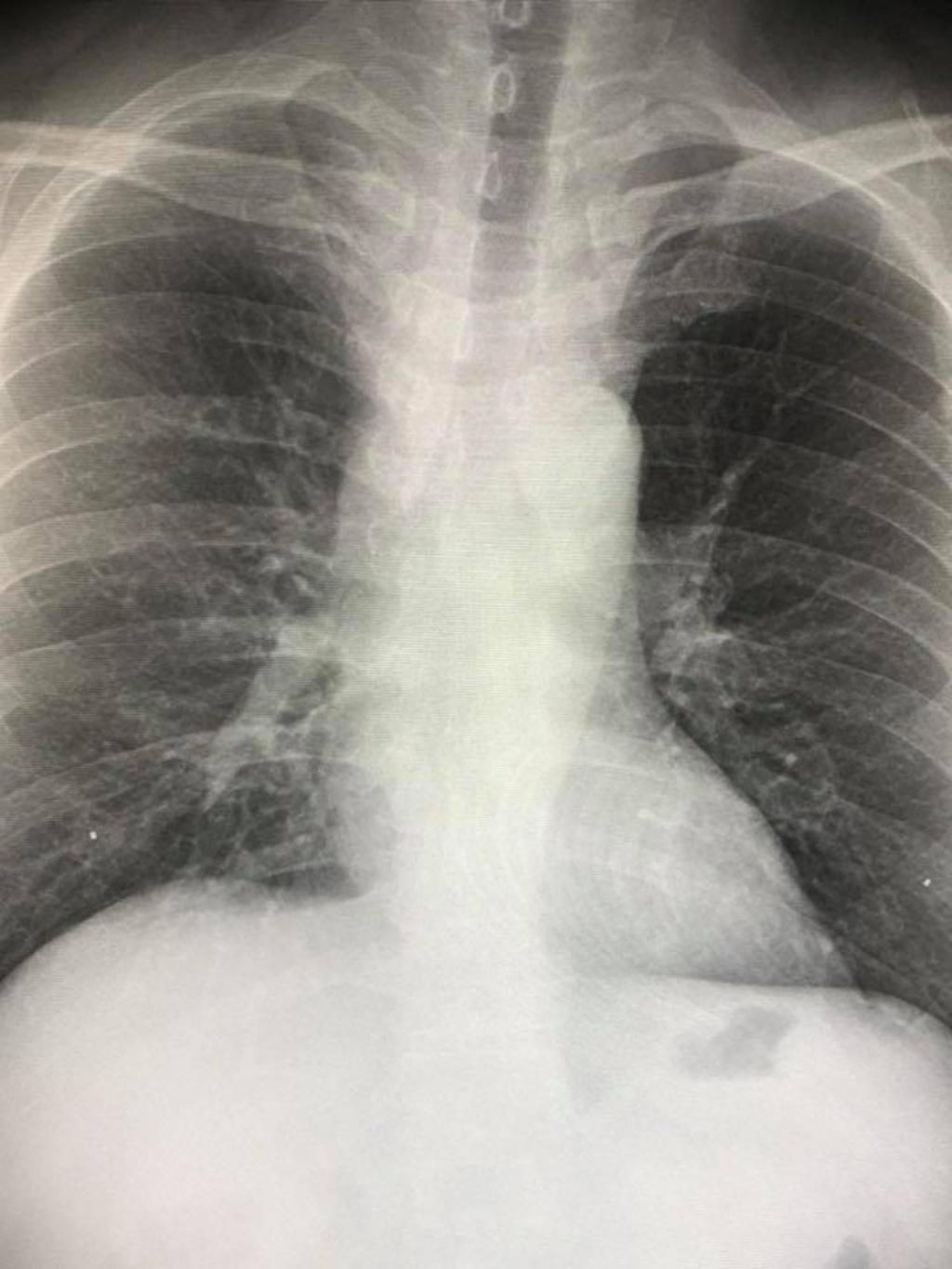 X-ray image  Cryptococcus fungal infection from breathing fungal spores from bird droppings Photo courtesy of Dr. Manoon Leechawengwong FC's Facebook page.