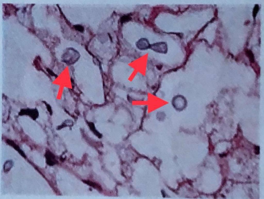 X-ray image  Cryptococcus fungal infection by breathing fungal spores from bird droppings.  Thanks for the picture from Facebook: Doctor Manoon Leechawengwong FC