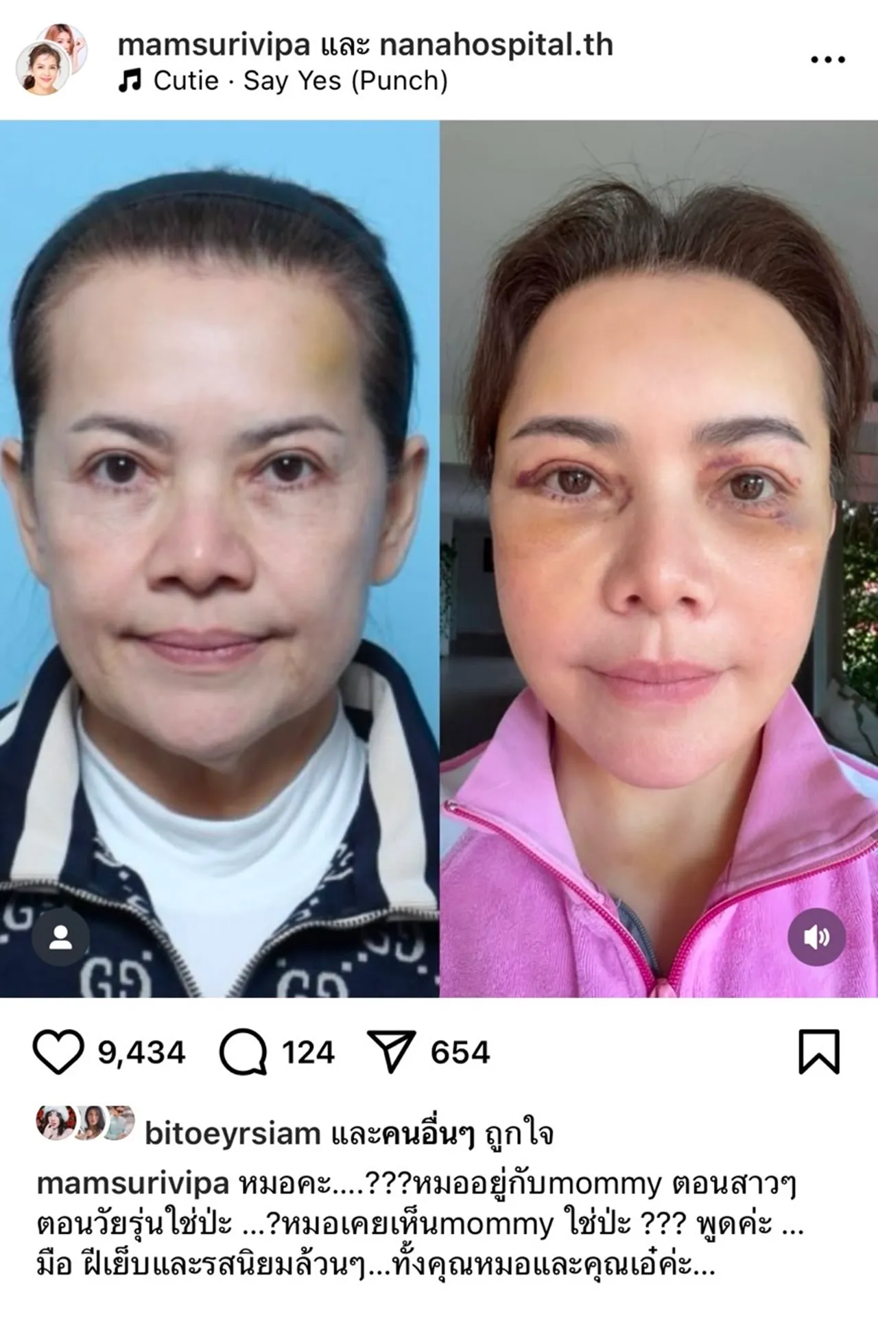 ว้าวมาก เปิดภาพ หนูแหม่ม สุริวิภา หลังทำศัลยกรรมยกหน้าใหม่ในวัย 58 ปี