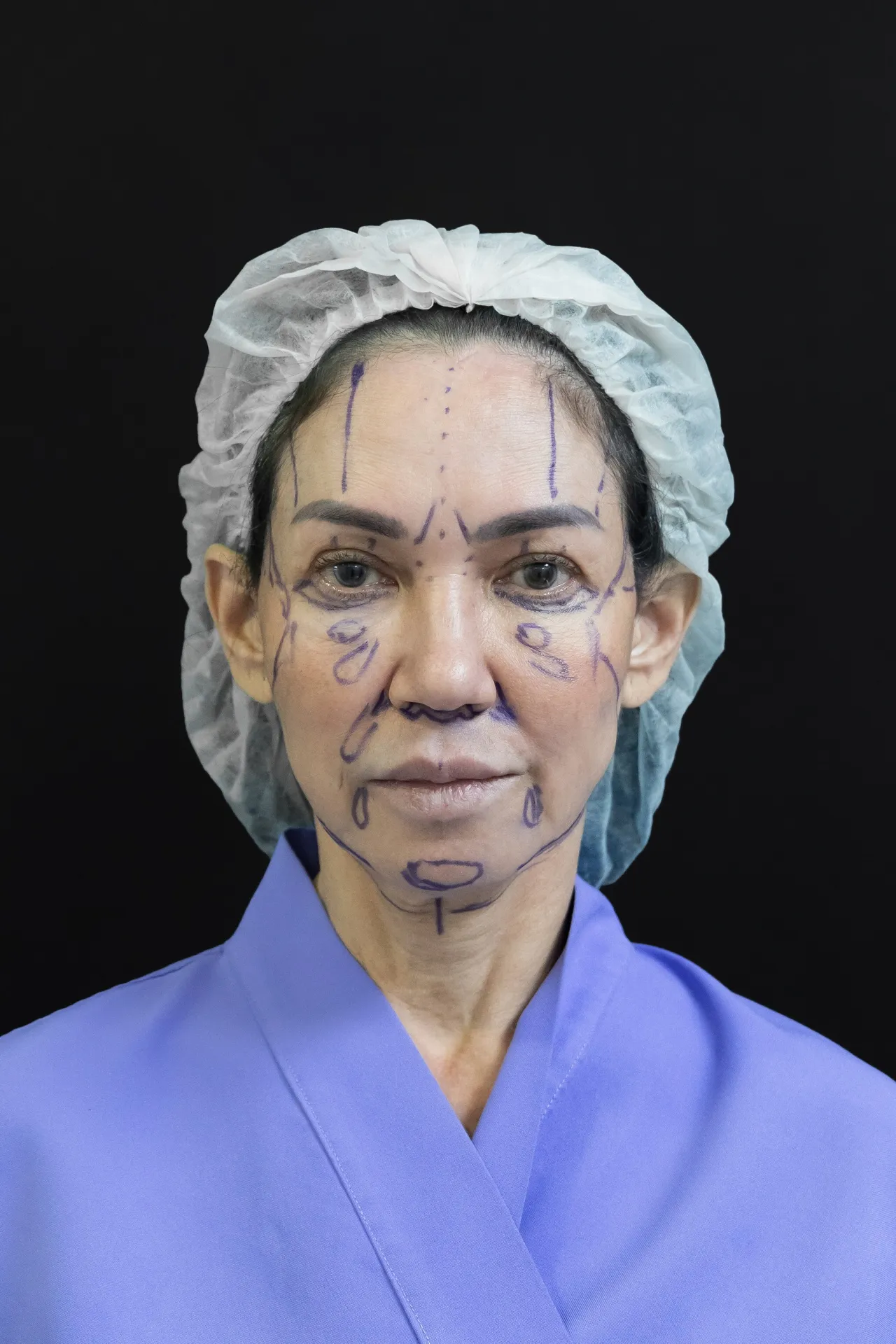 ดี้ ปัทมา เผยเบื้องหลังศัลยกรรม 8 ช.ม. ผ่า 6 จุด กว่าจะสวยเลือกหมอเกือบ 10 ปี