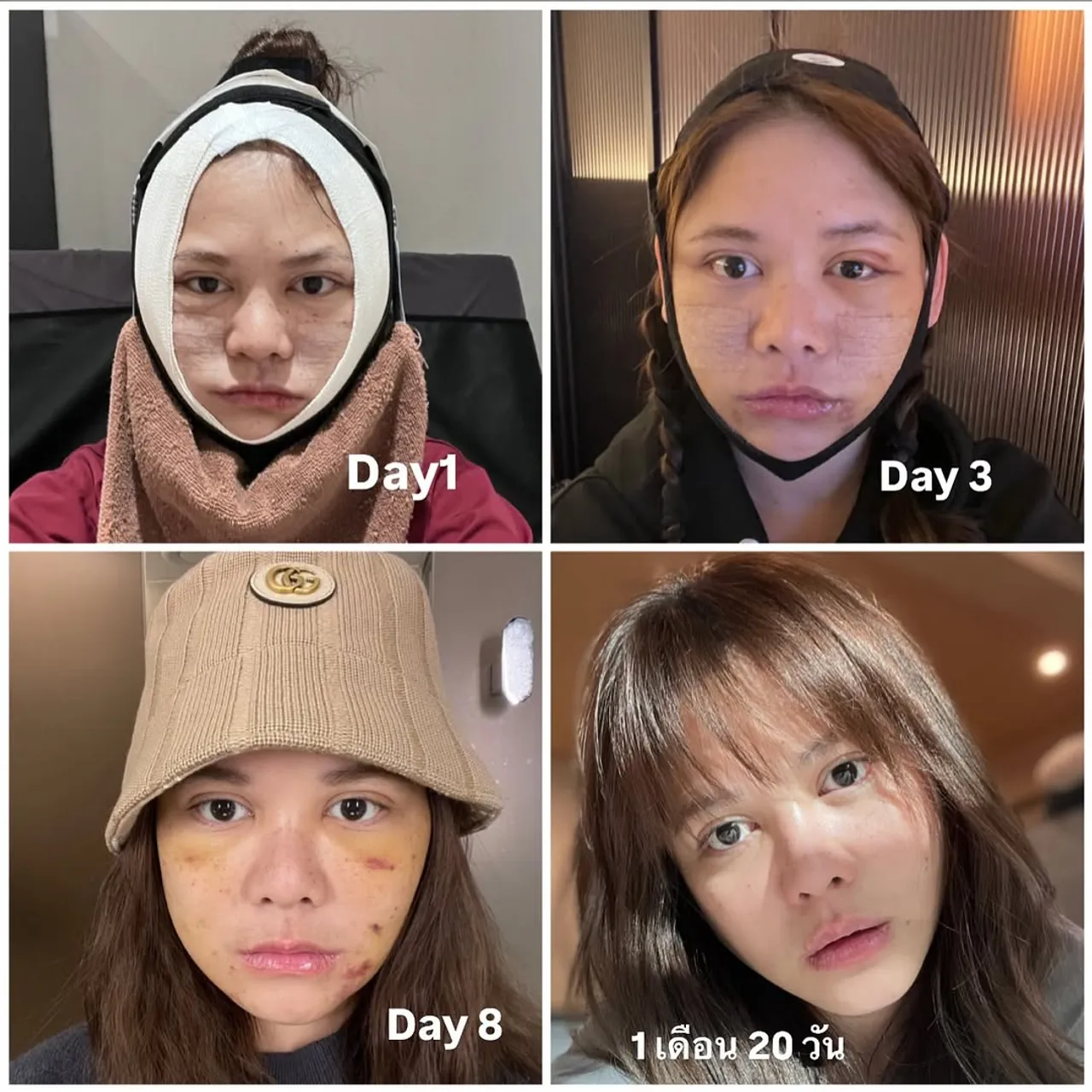 พิมพ์ พิมพ์มาดา รีวิวหลังผ่าตัดดึงหน้า แฟนๆ ชมสวยเหมือนตอนออกอัลบั้มแรก