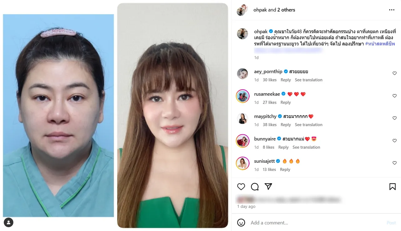 โอ๋ ภัคจีรา โพสต์รีวิวพลีชีพ เทียบภาพชัดๆ ก่อนและหลังศัลยกรรมวัย 48 ปี