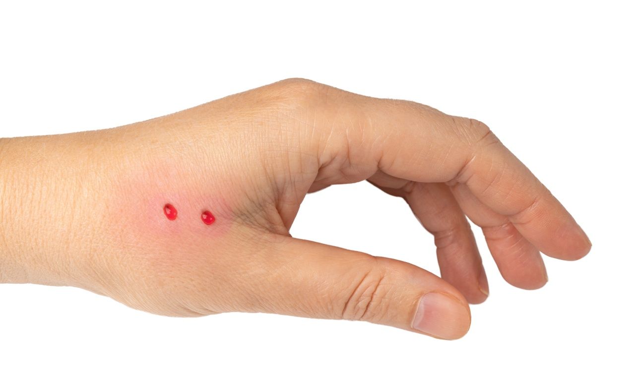 ลักษณะรอยกัดของงูพิษ (ภาพจาก iStock)