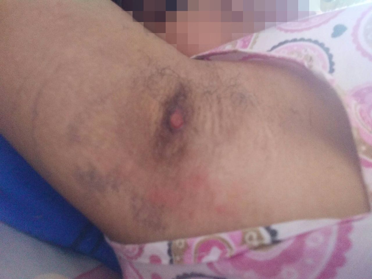 ภาพในปัจจุบัน ที่ต้องทนทุกข์ไม่สามารถยกแขนได้สุด 