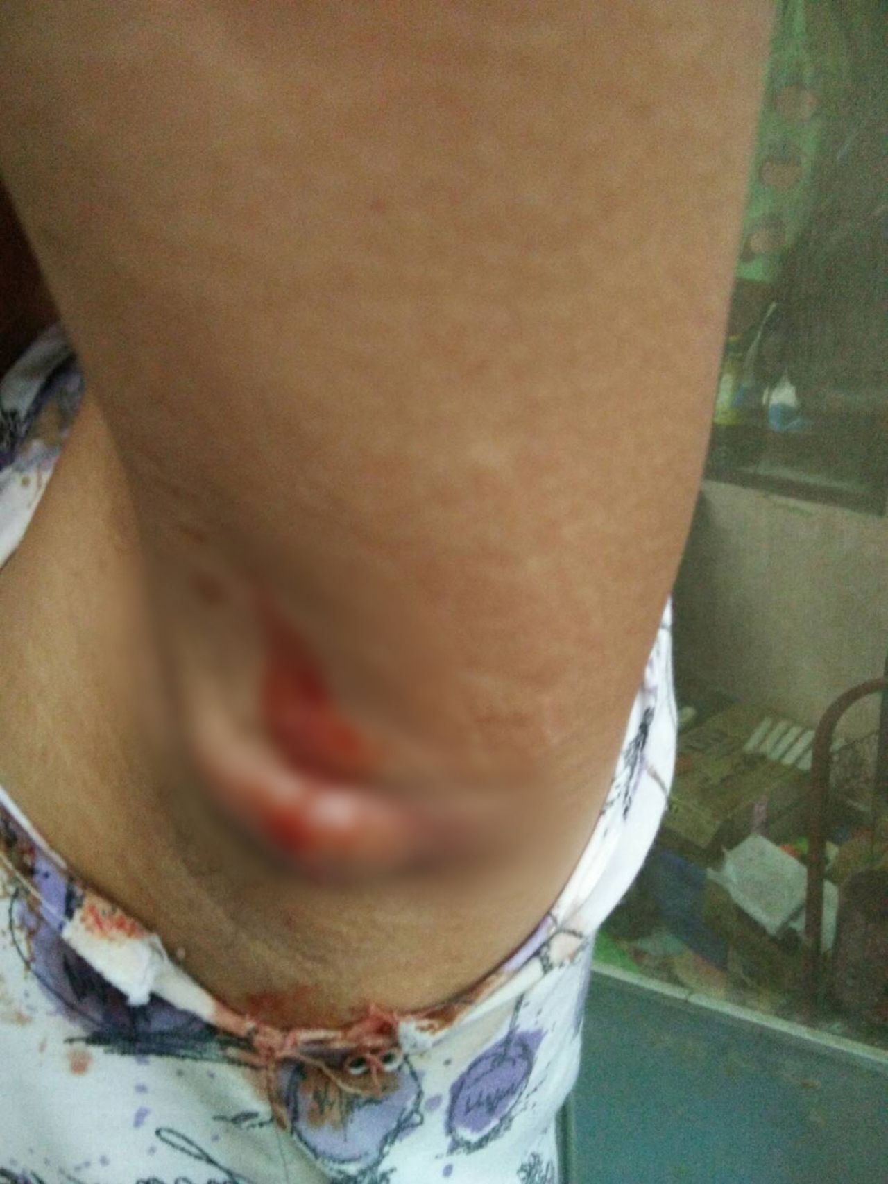 หลังใช้ 7 วัน ฝีแตก 