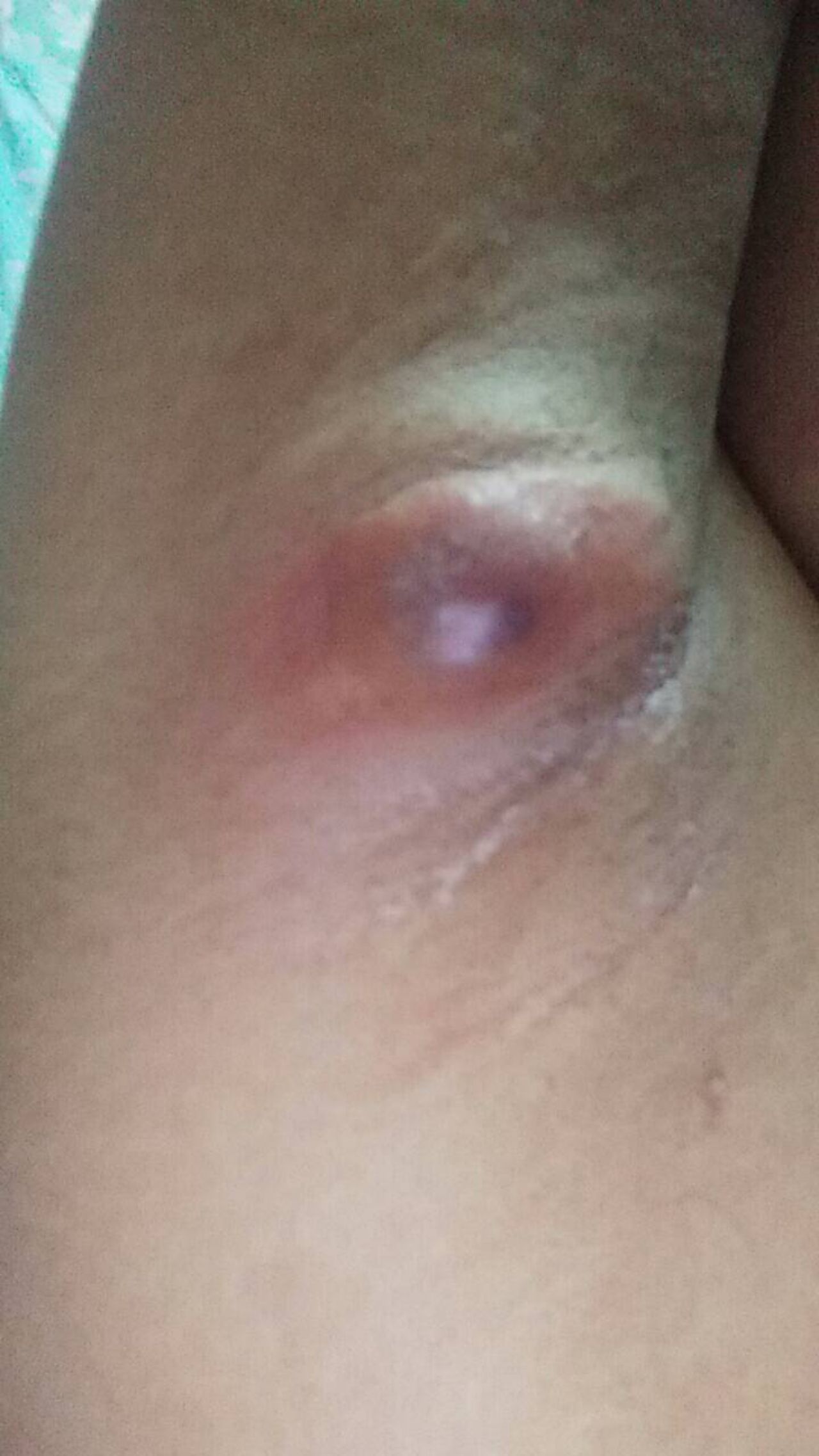 ใช้เซรั่ม ได้ 5 วัน 