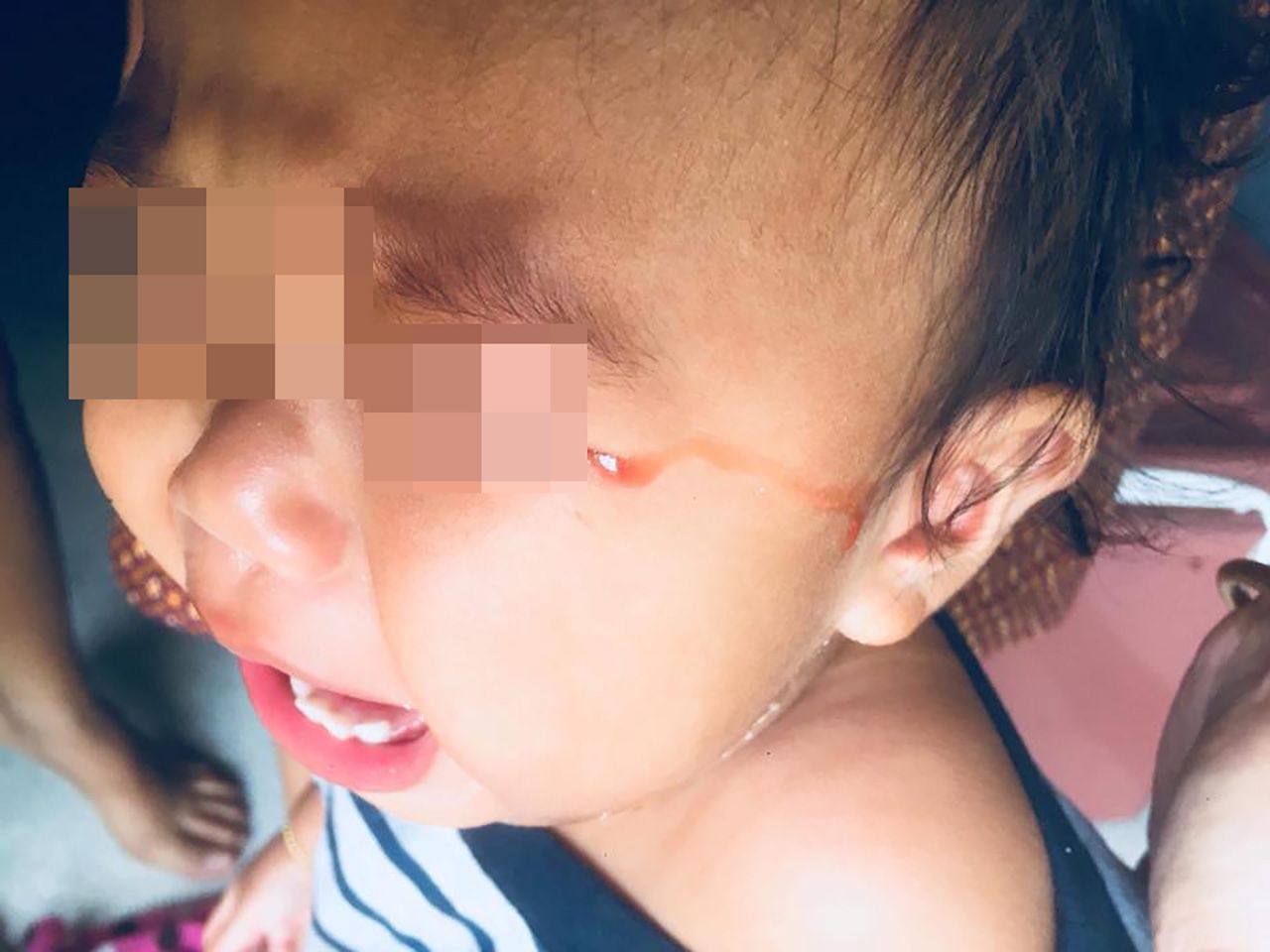 น้ำตาเป็นสายเลือด หมอชี้ปล่อยไว้นานเสี่ยงตาบอด