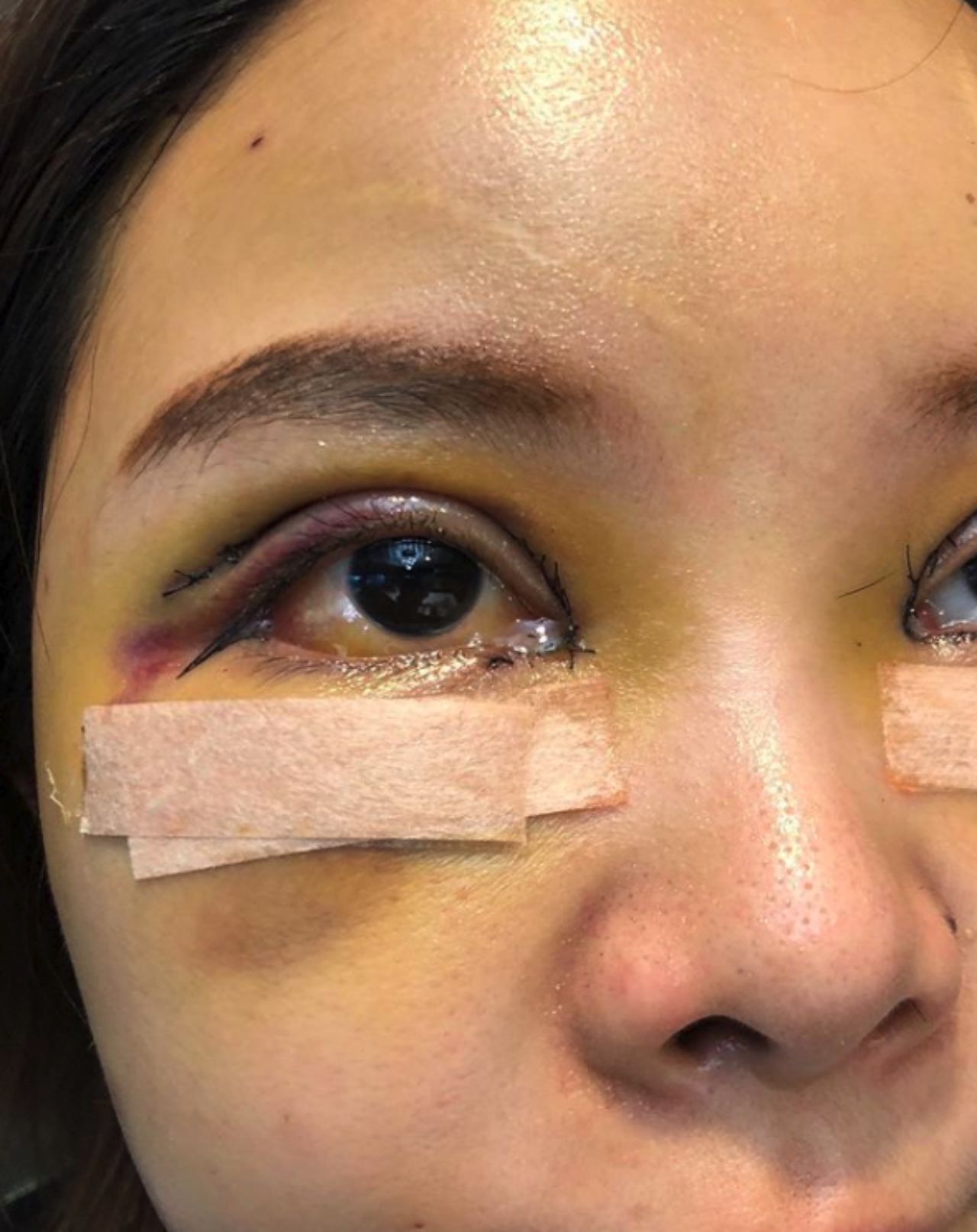 6 วันหลังทำ ถูกเย็บรัวๆ 