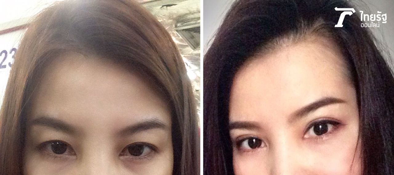 ภาพเปรียบเทียบ ก่อนและหลังทำตาสองชั้น