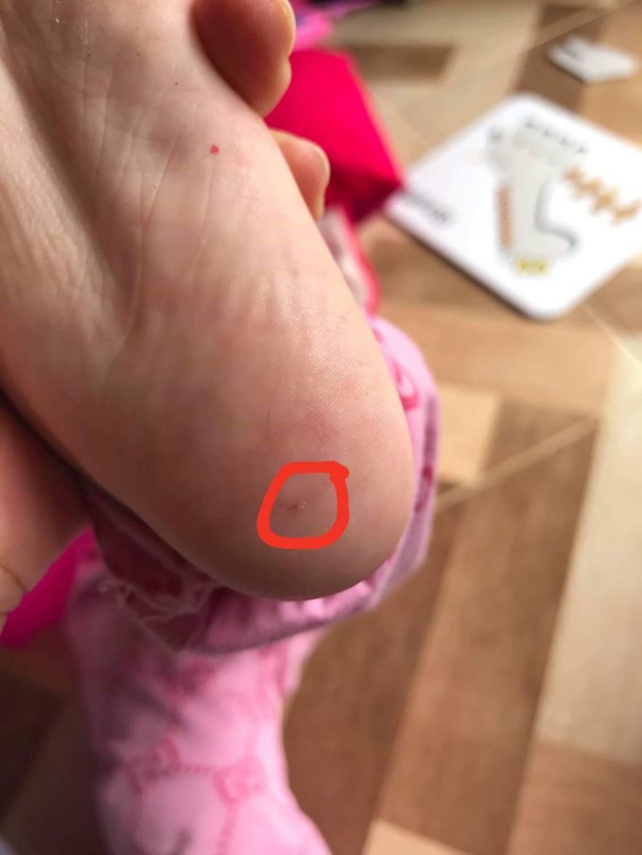 แผลนิดเดียวที่หมอกรีด และหนีบเส้นผมออกมา