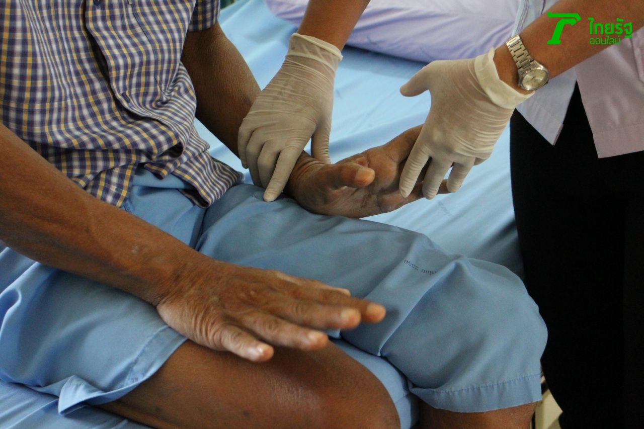 กายภาพบำบัดมือซ้าย