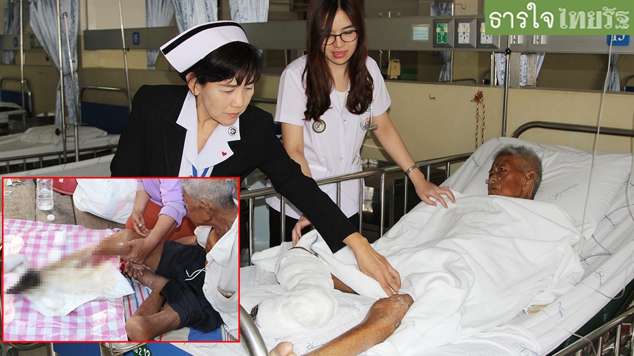 ส่งรพ.ด่วน ต้องตัดขารักษาชีวิต ตาหลีโดนผึ้งต่อย เนื้อตายเหลือแต่กระดูก