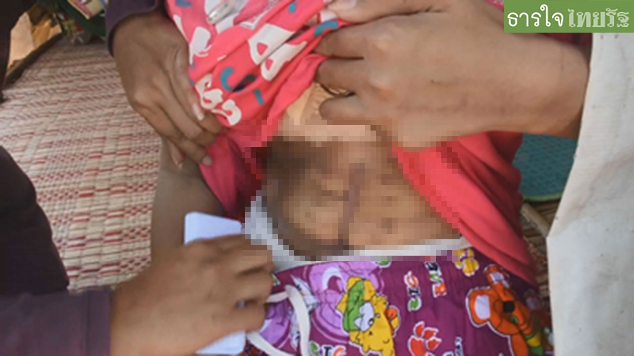 แสนสงสารสาว 15 ถูกพ่อขี้เมายิงไส้ขาด อยู่ตัวคนเดียว วอนช่วยส่งไปรักษา