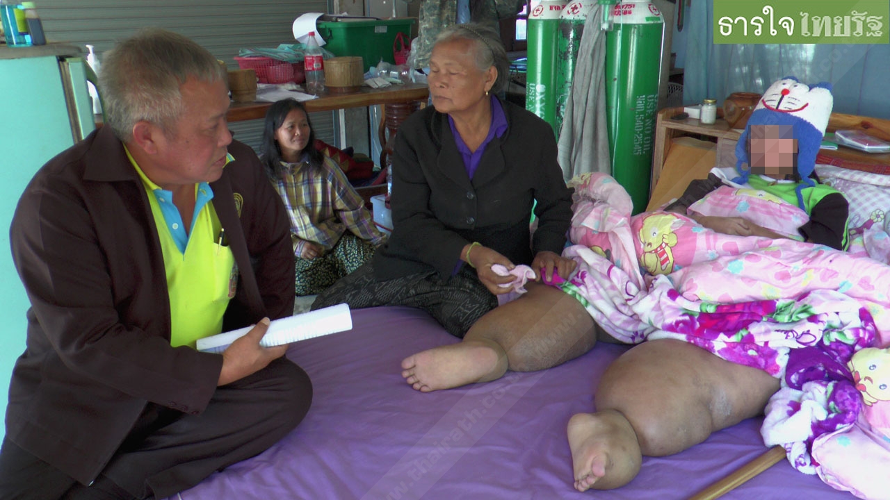 สุดเวทนา! สาว 17 ป่วยโรคขาโตนาน 3 ปี วอนช่วยเหลือ