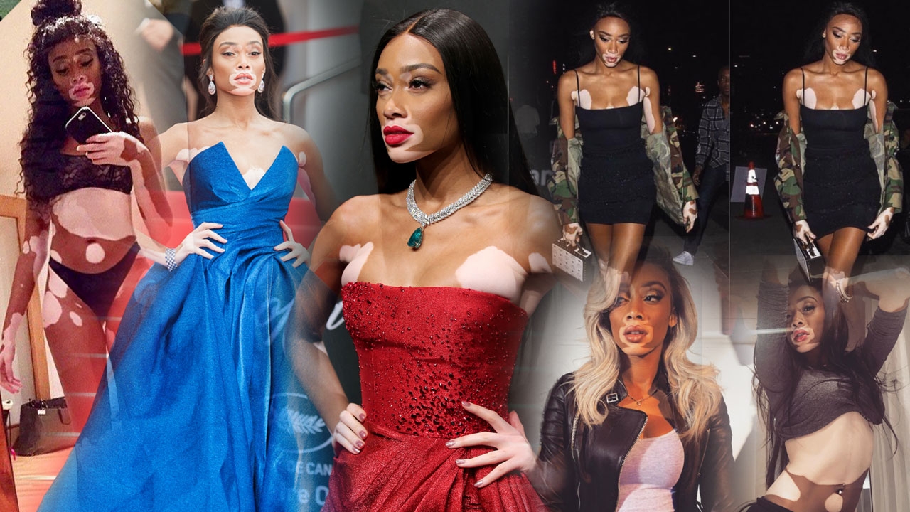 เฉิดฉายพรมแดงคานส์! รู้จักนางแบบด่างขาว ‘Winnie Harlow’ เธอดังระดับโลก