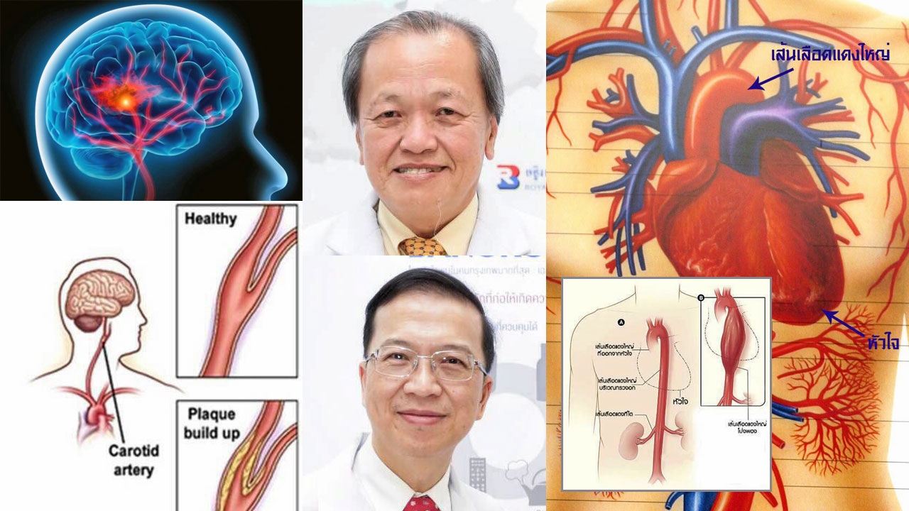 โรคหัวใจ-หลอดเลือด ภัย!เงียบเสี่ยงวูบ