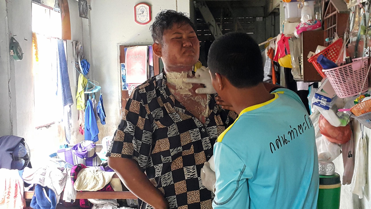 หญิงป่วยโรคผิวหนัง วอนใจบุญช่วยเหลือ