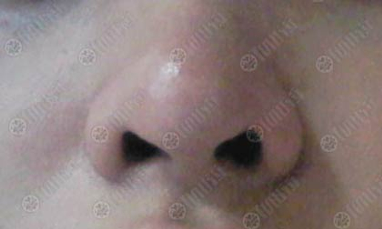 ตรวจมะเร็ง ด้วยลมหายใจ นักวิจัยยิวคิด'จมูกอิเล็กทรอนิกส์'รู้กลิ่นเนื้อร้าย