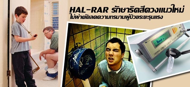 HAL-RAR รักษาริดสีดวงแนวใหม่ ไม่ผ่าตัดลดความทรมานผู้ป่วยระยะรุนแรง