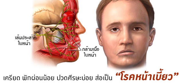 เครียด พักผ่อนน้อย ปวดศีรษะบ่อย ส่อเป็น "โรคหน้าเบี้ยว"