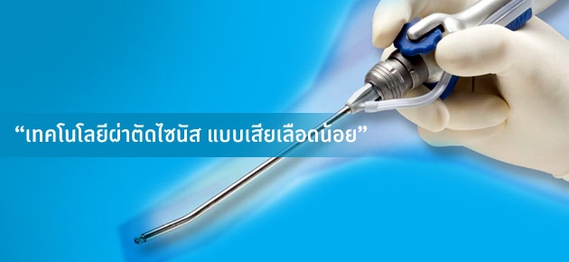 "เทคโนโลยีผ่าตัดไซนัส แบบเสียเลือดน้อย"