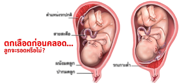 ตกเลือดก่อนคลอด…ลูกจะรอดหรือไม่?