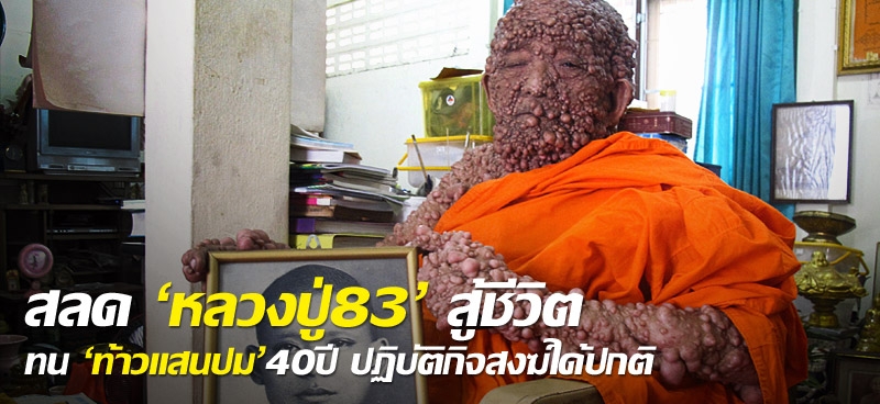 สลด 'หลวงปู่83' สู้ชีวิต ทน 'ท้าวแสนปม'40ปี ปฏิบัติกิจสงฆ์ได้ปกติ