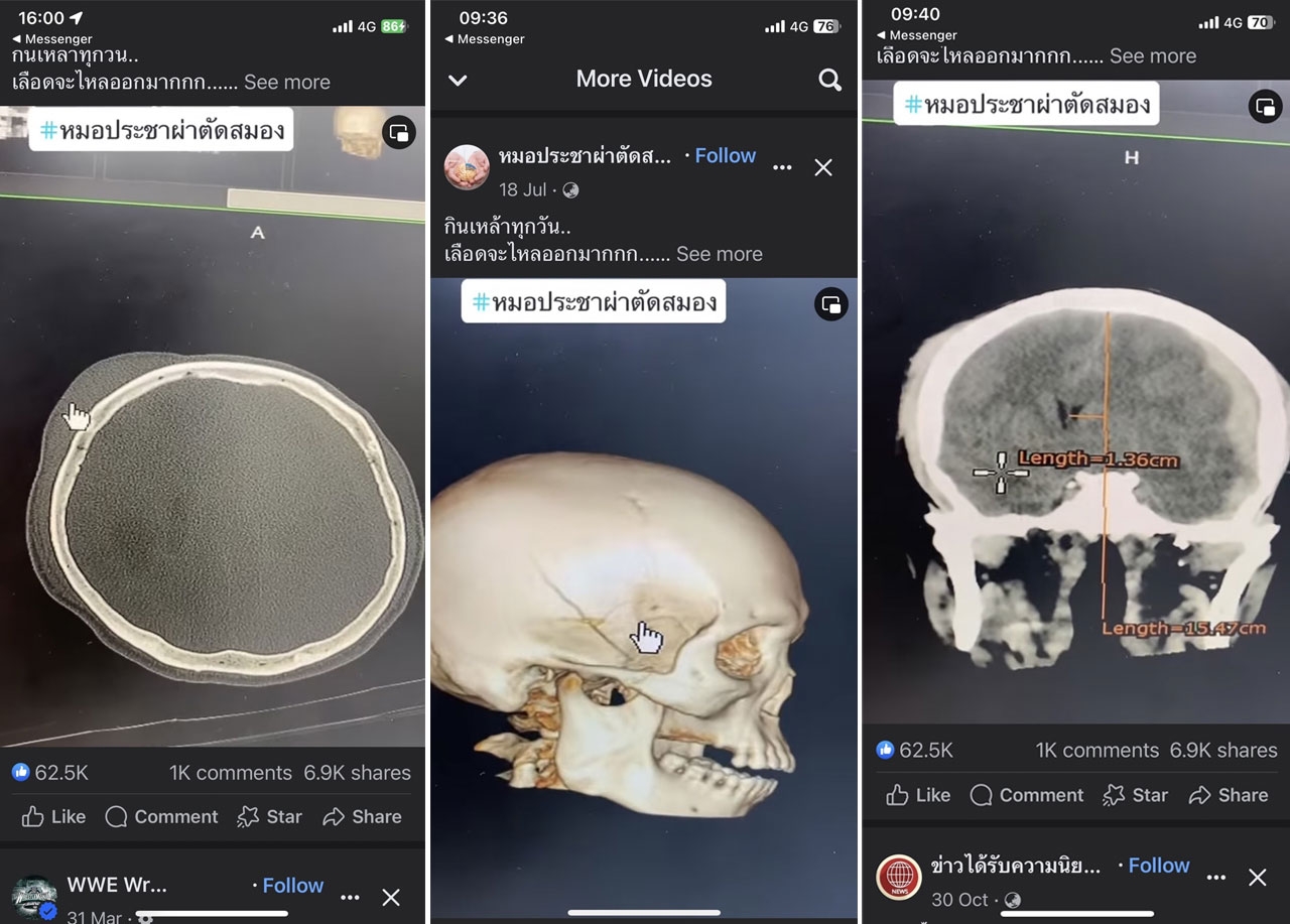 ภาพจากซ้ายไปขวา ภาพสแกนศีรษะมีอาการบวม , ภาพสแกนกะโหลกร้าวจากแรงกระแทก , ภาพสแกนสมองเคลื่อนจากตำแหน่ง 1.36 เซนติเมตร